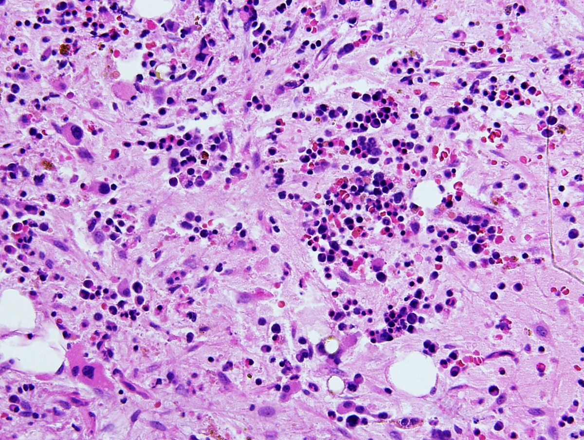 Bone marrow biopsy 20x